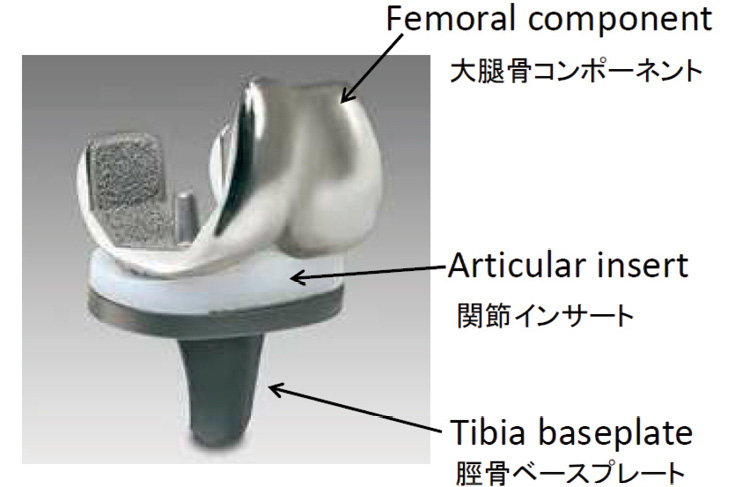 図4.25　人工膝関節造